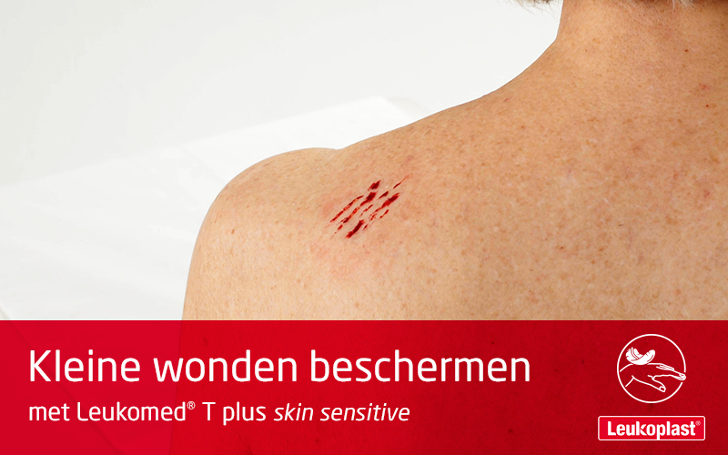 Deze video demonstreert het gebruik van een transparante wondfolie op een kwetsbare huid. We zien de handen van een zorgprofessional die Leukomed T skin sensitive aanbrengt op de schouder van een oudere dame. Deze video demonstreert het gebruik van een transparante wondfolie op een kwetsbare huid. We zien de handen van een zorgprofessional die Leukomed T skin sensitive aanbrengt op de schouder van een oudere dame.